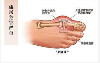 痛風病人吃什么好？ 飲食需合理搭配