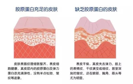 注射膠原蛋白真的能改善臉部皺紋？